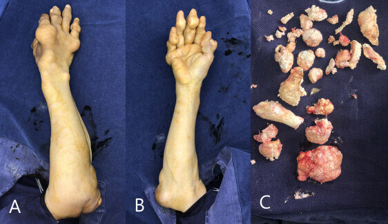 혐) 새벽을 일깨우는 내성발톱, 통풍, 사마귀_6.jpg