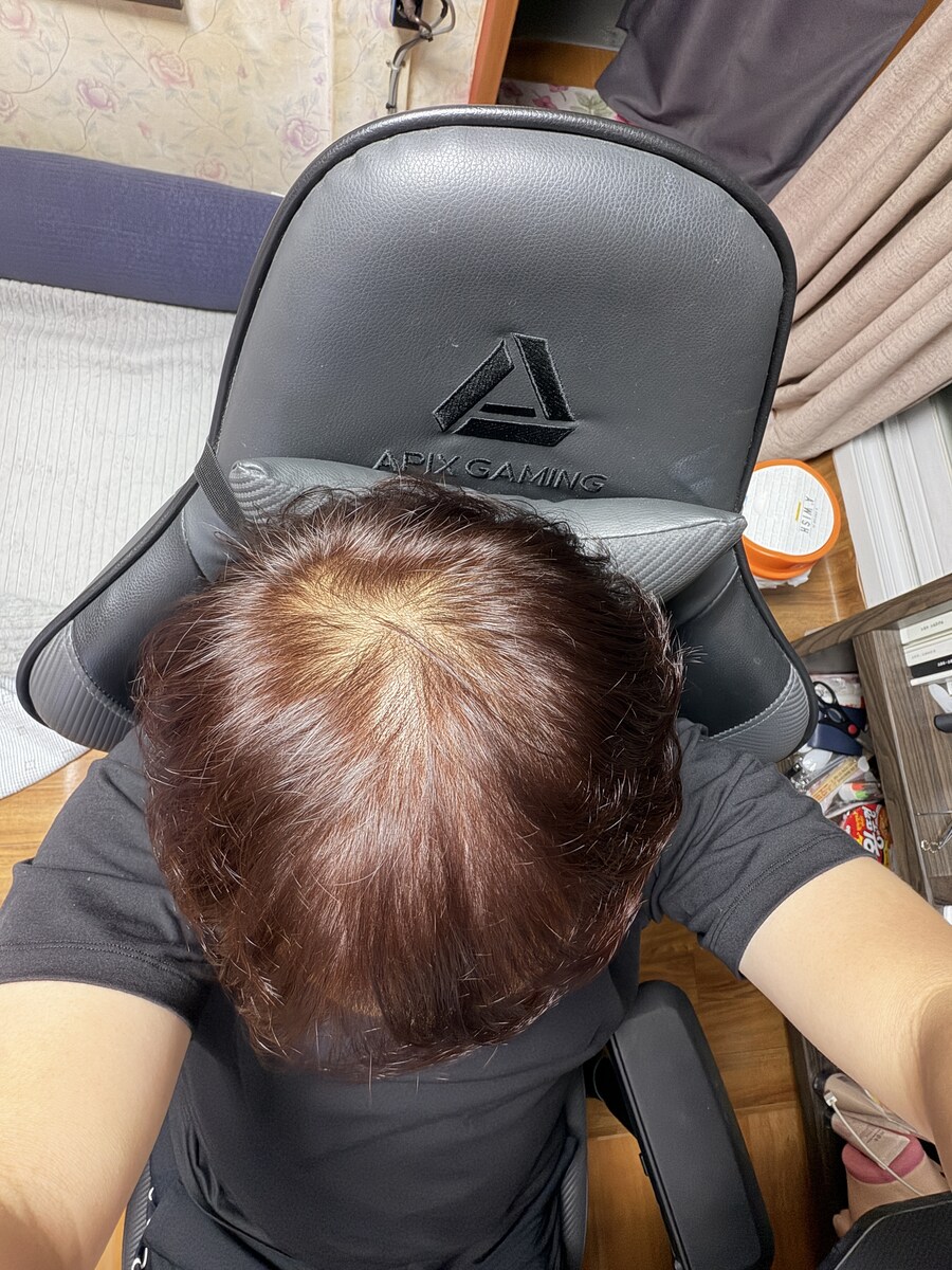 제머리 탈모인것같은데...약먹는게 좋을까요?_2.jpg