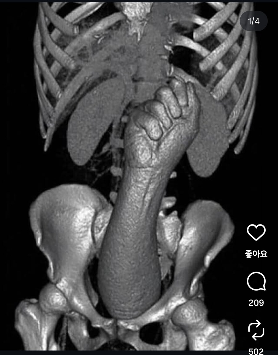 혐) 항문에 이물이 들어간 사람들의 변명_2.jpg