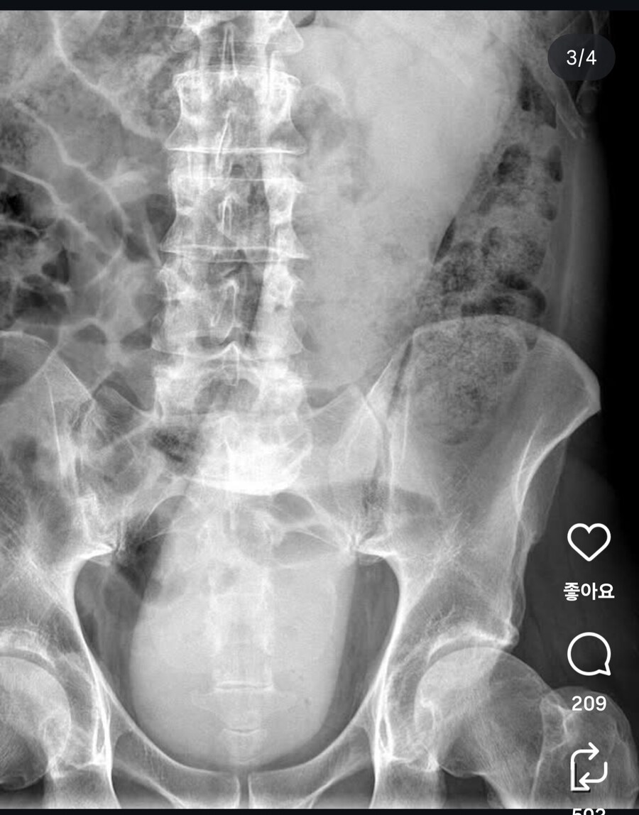 혐) 항문에 이물이 들어간 사람들의 변명_4.jpg