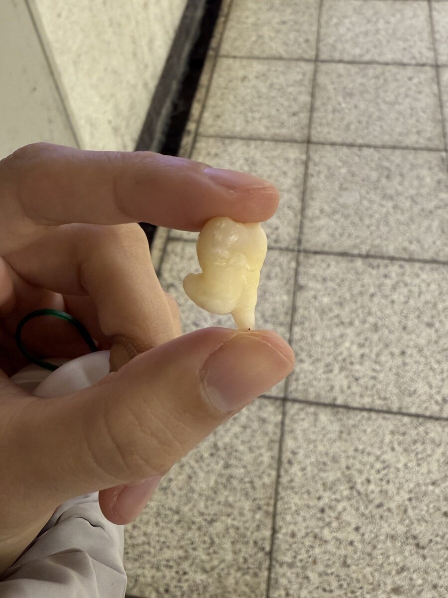 일본에서 화제가 된 어느 모델의 사랑니_3.jpg