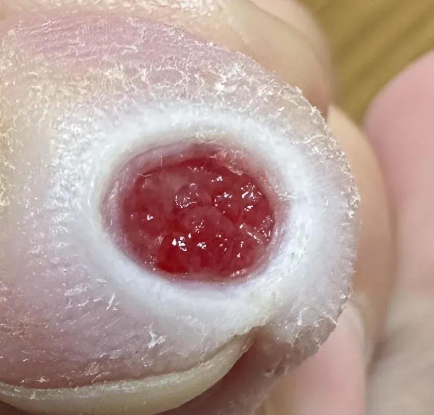 혐) 티눈갤러리 칠성장어 갤주 근황.jpg_2.webp