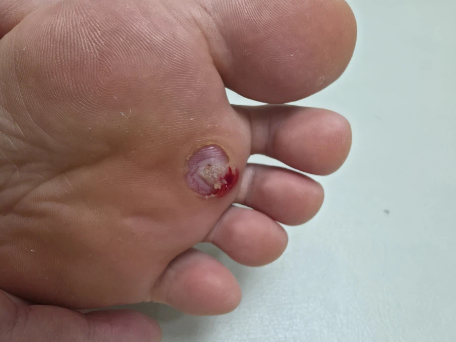 혐짤주의) 사마귀 치료 아프다_2.webp