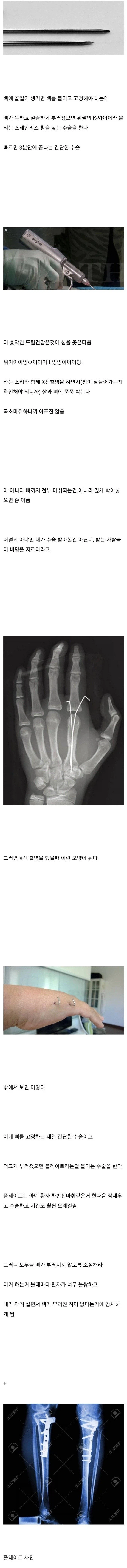 뼈 안 부러져본 사람들이 의외로 모르는 사실_1.webp