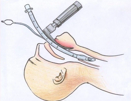 복어 잘못먹었을때 치료 방식_1.webp