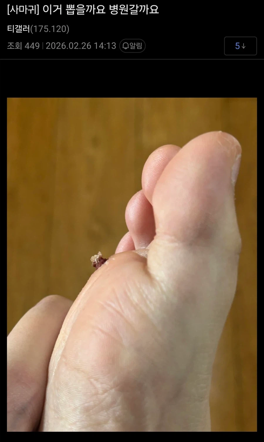 (혐) 티눈갤 근황_3.webp