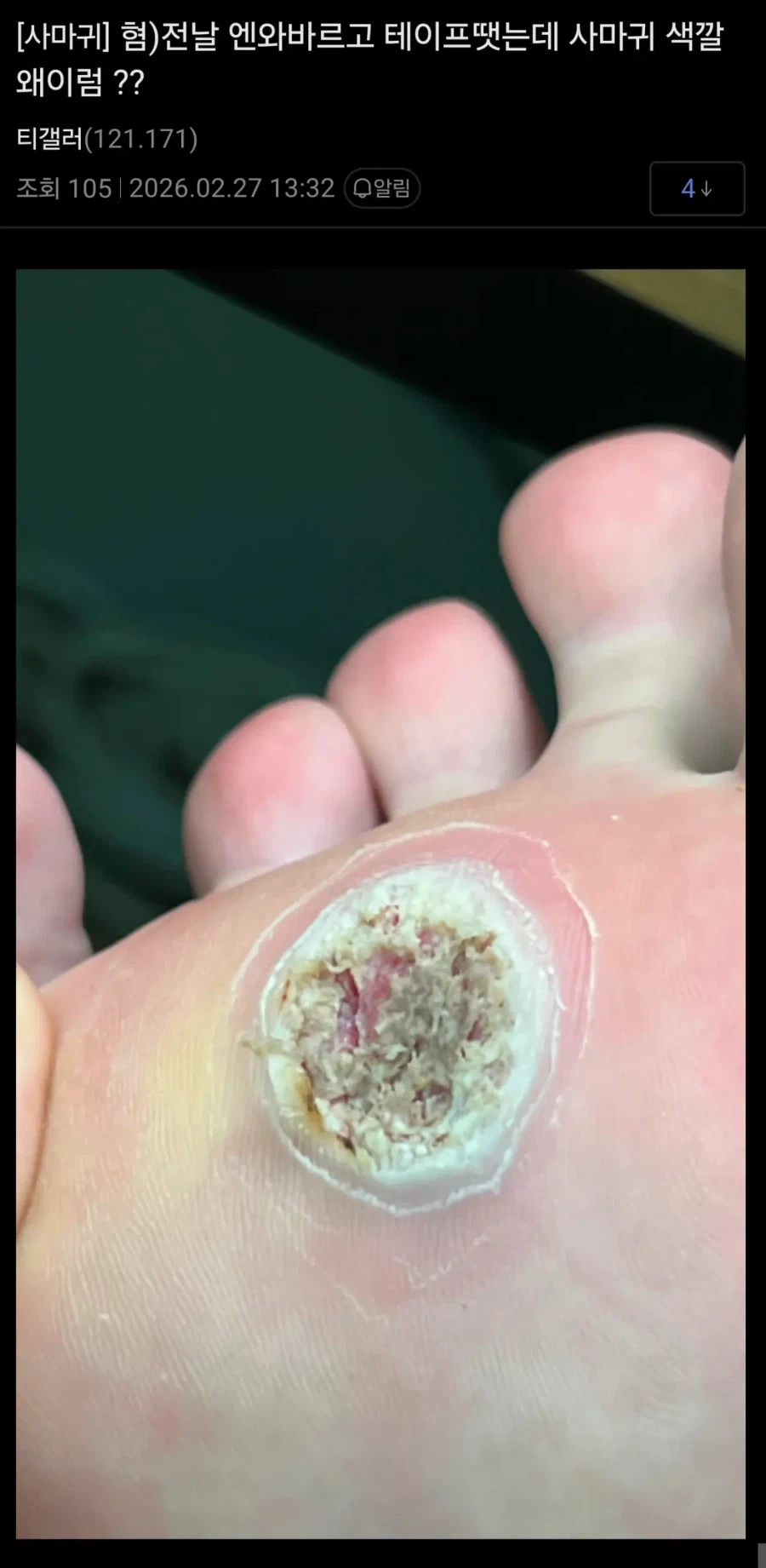 혐) 티눈갤 근황_2.webp