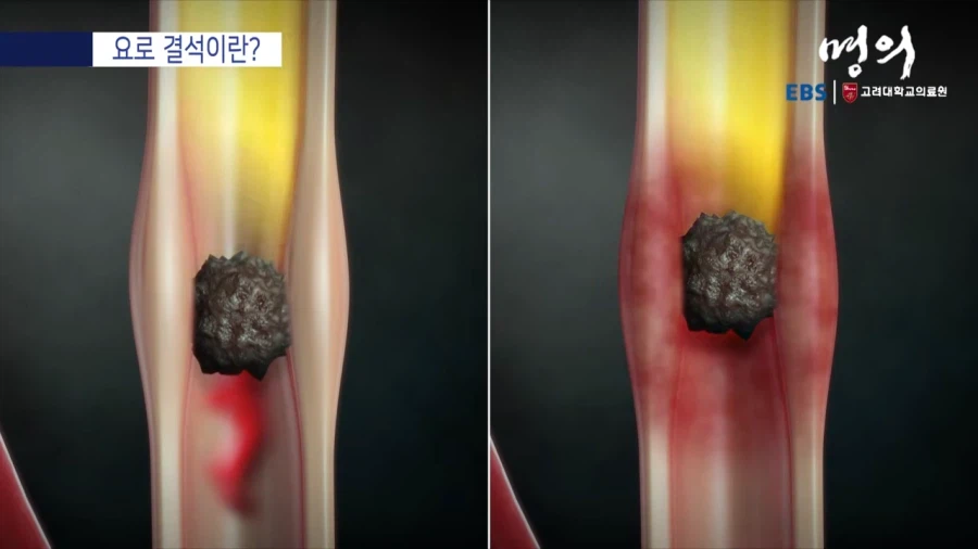 요로 결석이란?_9.webp