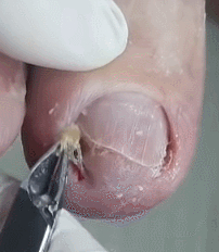 내성발톱 제거_7.gif