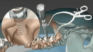 사이버펑크 2077 2.0 업뎃 기념 현실 산데비슷한 수술 장면_2.gif